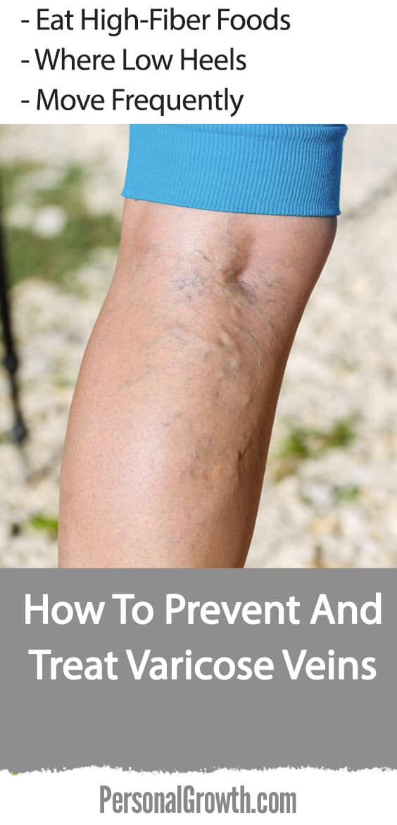 how-to-prevent-and-treat-varicose-veins-pin